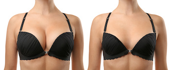 Breast Reduction Before After