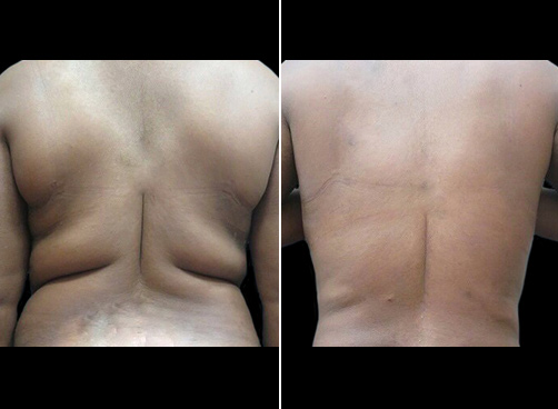 Liposuction Before After